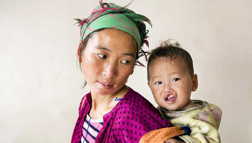 Operation Smile gives children with facial deformities a new start