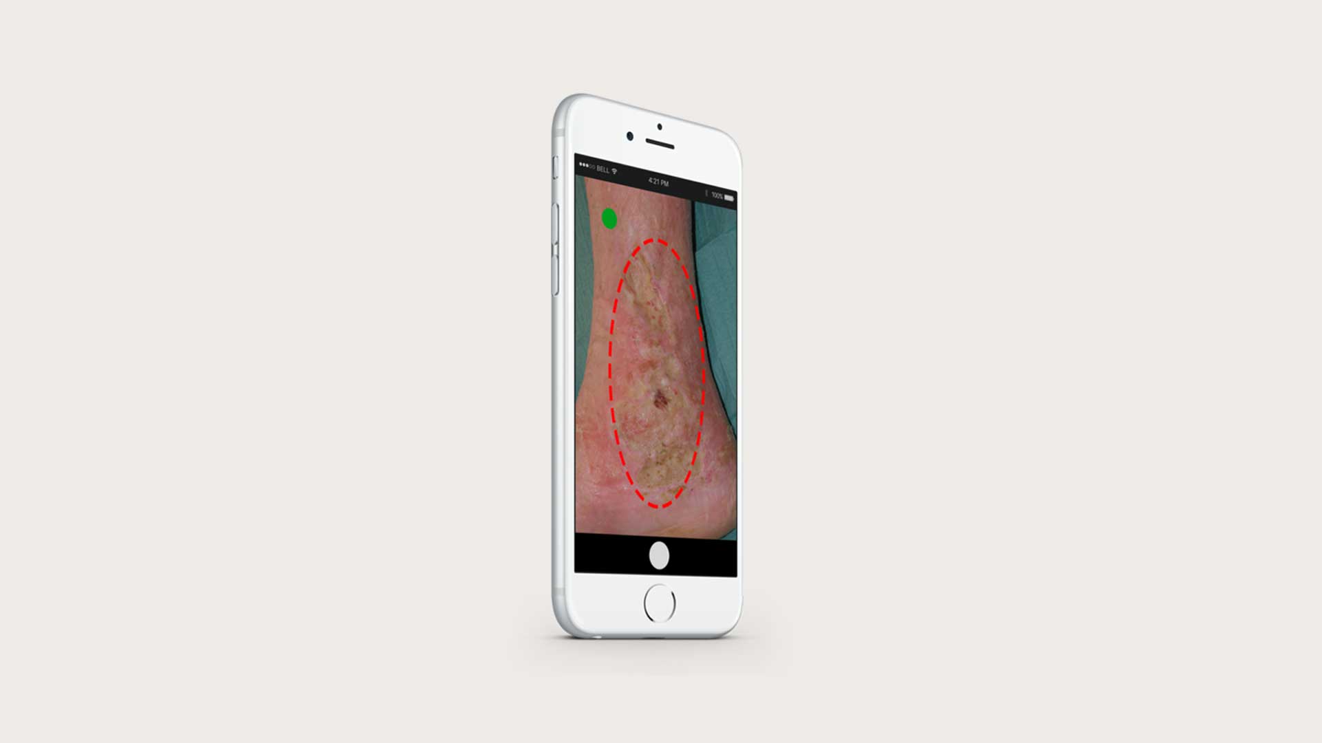 wound imaging app showing diabetic foot ulcer